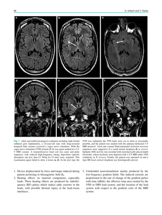 1. Device displacement by force and torque induced during
patient positioing in themagmetic ﬁeld B0.
2. Heating effects on material components, especially
leads. These heating effects are produced by radiofre-
quency (RF) pulses which induce eddy currents in the
leads, with possible thermal injury at the lead–tissue
interfaces.
3. Unintended neurostimulation mainly produced by the
low-frequency gradient ﬁelds. The induced currents are
proportional to the rate of change of the gradient pulses
with time (dB/dt), the effective loop area created by the
VNS or DBS lead system, and the location of the lead
system with respect to the gradient coils of the MRI
system.
Fig. 1 After uneventful presurgical evaluation including right frontal
subdural grid implantation, a 24-year-old man with drug-resistant
temporal lobe seizures received a vagus nerve stimulator. With the
vagus nerve stimulator (VNS) turned off, he was again studied in a 1.5-
T MRI scanner. A transmit/receive head coil was used, and pulse
sequences with reduced high-frequency energy deposition (speciﬁc
absorption rate less than 0.1 W/kg for 15 min) were acquired. This
examination again failed to show a lesion (a, d). In the next step, the
VNS was explanted, the VNS leads were cut as short as reasonably
possible, and the patient was studied with the epilepsy-dedicated 3-T
MRI protocol. Axial and coronal ﬂuid-attenuated inversion recovery
sequences were suggestive of a small insular dysplasia (b, e, arrow).
Epileptic EEG activity was recorded with stereotactically placed depth
electrodes, whose positions were depicted with 1.5-T MRI under VNS
conditions (c, f, arrows). Finally, the patient was operated on and a
type IIB focal cortical dysplasia was histologically proven
86 H. Urbach and S. Flacke
 