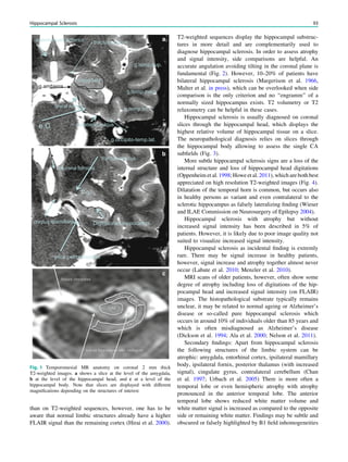 amygdala
g.ambiens
collateral sulcus
tractus opticus
g.occipito-temp.lat.
g.temp.sup.
g.temp.med.
g.temp.inf.
commissura anterior
e.C
.
uncal notch
tractus opticus
corpus mamillare Digitationes hippocampi
C.g.l
plica petroclinoidea
columna fornicis
a
b
c
Fig. 1 Temporomesial MR anatomy on coronal 2 mm thick
T2-weighted images. a shows a slice at the level of the amygdala,
b at the level of the hippocampal head, and c at a level of the
hippocampal body. Note that slices are displayed with different
magniﬁcations depending on the structures of interest
than on T2-weighted sequences, however, one has to be
aware that normal limbic structures already have a higher
FLAIR signal than the remaining cortex (Hirai et al. 2000).
T2-weighted sequences display the hippocampal substruc-
tures in more detail and are complementarily used to
diagnose hippocampal sclerosis. In order to assess atrophy
and signal intensity, side comparisons are helpful. An
accurate angulation avoiding tilting in the coronal plane is
fundamental (Fig. 2). However, 10–20% of patients have
bilateral hippocampal sclerosis (Margerison et al. 1966,
Malter et al. in press), which can be overlooked when side
comparison is the only criterion and no ‘‘engramm’’ of a
normally sized hippocampus exists. T2 volumetry or T2
relaxometry can be helpful in these cases.
Hippocampal sclerosis is usually diagnosed on coronal
slices through the hippocampal head, which displays the
highest relative volume of hippocampal tissue on a slice.
The neuropathological diagnosis relies on slices through
the hippocampal body allowing to assess the single CA
subﬁelds (Fig. 3).
More subtle hippocampal sclerosis signs are a loss of the
internal structure and loss of hippocampal head digitations
(Oppenheim etal. 1998; Howeetal. 2011), which are both best
appreciated on high resolution T2-weighted images (Fig. 4).
Dilatation of the temporal horn is common, but occurs also
in healthy persons as variant and even contralateral to the
sclerotic hippocampus as falsely lateralizing ﬁnding (Wieser
and ILAE Commission on Neurosurgery of Epilepsy 2004).
Hippocampal sclerosis with atrophy but without
increased signal intensity has been described in 5% of
patients. However, it is likely due to poor image quality not
suited to visualize increased signal intensity.
Hippocampal sclerosis as incidental ﬁnding is extremly
rare. There may be signal increase in healthy patients,
however, signal increase and atrophy together almost never
occur (Labate et al. 2010; Menzler et al. 2010).
MRI scans of older patients, however, often show some
degree of atrophy including loss of digitations of the hip-
pocampal head and increased signal intensity (on FLAIR)
images. The histopathological substrate typically remains
unclear, it may be related to normal ageing or Alzheimer’s
disease or so-called pure hippocampal sclerosis which
occurs in around 10% of individuals older than 85 years and
which is often misdiagnosed as Alzheimer’s disease
(Dickson et al. 1994; Ala et al. 2000; Nelson et al. 2011).
Secondary ﬁndings: Apart from hippocampal sclerosis
the following structures of the limbic system can be
atrophic: amygdala, entorhinal cortex, ipsilateral mamillary
body, ipsilateral fornix, posterior thalamus (with increased
signal), cingulate gyrus, contralateral cerebellum (Chan
et al. 1997; Urbach et al. 2005) There is more often a
temporal lobe or even hemispheric atrophy with atrophy
pronounced in the anterior temporal lobe. The anterior
temporal lobe shows reduced white matter volume and
white matter signal is increased as compared to the opposite
side or remaining white matter. Findings may be subtle and
obscured or falsely highlighted by B1 ﬁeld inhomogeneities
Hippocampal Sclerosis 93
 