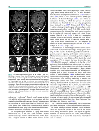 and narrow ‘‘windowing’’. There is usually an a.p. gradient
with a higher white matter signal in the temporal pole that
gradually diminishs and is already absent if slices through
the amygdala or hippocampal head are inspected. Since
white matter has a higher signal, contrast to gray matter is
reduced and the term ‘‘gray white matter demarcation loss’’
has been designated to describe this condition.
The histopathological substrate of ‘‘gray white matter
demarcation loss’’ is not clear. Some describe a higher
amount of ectopic neurons within the white matter, how-
ever, a higher amount of white matter neurons in the
anterior temporal lobe is also physiologic. Some consider
‘‘gray white matter demarcation loss’’ as mild maforma-
tion of cortical development (Palmini et al. 2004; Blümcke
et al. 2011), others as focal cortical dysplasias (FCD) type
I (Fauser et Schulze-Bonhage 2006), and others as
maturation disorder, in which the process of cerebral
myelination is disturbed due to an early precipitating
injury (Mitchell et al. 2003; Schijns et al. 2011). Recent
work investigating the pathological substrate of gray-white
matter demarcation loss with 7 Tesla MRI revealed dish-
omogeneous myelin staining of the white matter, reduction
in the number of axons and presence of axonal degen-
eration (Garbelli et al. 2012). A hint for a maturation
disorder are early precipitating injuries and early seizure
onset (often before the age of two) of patients with a
‘‘gray white matter demarcation loss’’ as compared to
those who do not have these changes (Mitchell et al. 2003;
Schijns et al. 2011). (Figs. 5, 6).
In around 10% of patients hippocampal sclerosis is asso-
ciated with another extrahippocampal epileptogenic lesion
(Fig. 7). This is called dual pathology and associated with a
poorer prognosis regarding postsurgical seizure outcome.
Most common dual lesions are cortical dysplasias and gliotic
lesions acquired in early childhood. Note that in the initial
description 30% of patients had dual lesions (Levesque
1991). This high number is explained by the fact that 10% of
patients in this series had gliomas and temporal lobe seizures.
They underwent hippocamopectomy and showed only mild
hippocampal cell loss on histopathology. Some authors
consider ‘‘gray white matter demarcation loss’’ of the anterior
temporal pole as type I dysplasia and thus a dual lesion
(Fauser et Schulze-Bonhage 2006). In order to have a strict
deﬁnition of dual pathology, the ILAE proposed the follow-
ing deﬁnition: Dual Pathology refers only to patients with
hippocampal sclerosis, who have a second principal lesion
affecting the brain (which may be located also outside the
ipsilateral temporal lobe), that is, tumor, vascular malfor-
mation, glial scar, limbic/Rasmussen encephalitis, or MCD
(including FCD Type IIa/IIb). Ipsilateral temporopolar atro-
phy with increased T2 signal changes on MRI is not included
as its histopathologic correlate has yet to be speciﬁed. Hist-
opathologically conﬁrmed architectural abnormalities in the
temporal lobe associated with hippocampal sclerosis should
not be diagnosed as FCD Type I or ‘‘Dual Pathology’’ but
FCD Type IIIa (Blümcke et al. 2011).
PET: positron emission tomography (PET) has become
part of the presurgical evaluation in many epilepsy centers.
The central ﬁnding is that the temporal lobe is hypomet-
abolic for uptake of glucose on the side of the seizure
focus during the interictal period. The region of hypome-
tabolism can be both medial and lateral, and commonly
exceeds the size of tissue that needs to be removed for
cure of seizures.
Fig. 2 Left-sided hippocampal sclerosis (a, b: coronal 3 mm thick
FLAIR, c–e: coronal 2 mm thick T2-weighted fast spin echo images)
indicated by increased signal intensity and atrophy of the left
hippocampus. These ﬁndings are best appreciated on slices through
the hippocampal head (a, c, e: arrow) since they contain the highest
amount of hippocampal tissue per slice. In contrast, neuropathological
diagnosis is based on slices through the hippocampal body (b, d, f),
which allow a better anatomical orientation with respect to the CA
subﬁels. In order to allow side comparisons tilting in the coronal plane
must be avoided. Exact angulation is proven by displaying small pairy
structures (e.g. columnae fornicis (e: hollow arrow); semicircular
canals) on one slice.
94 H. Urbach
 