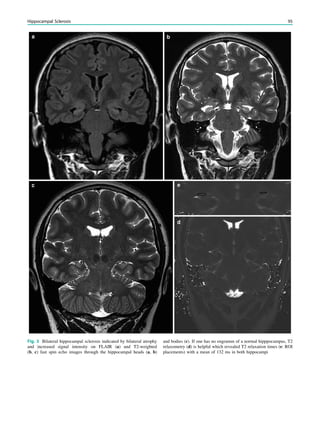 Fig. 3 Bilateral hippocampal sclerosis indicated by bilateral atrophy
and increased signal intensity on FLAIR (a) and T2-weighted
(b, c) fast spin echo images through the hippocampal heads (a, b)
and bodies (c). If one has no engramm of a normal hipppocampus, T2
relaxometry (d) is helpful which revealed T2 relaxation times (e: ROI
placements) with a mean of 132 ms in both hippocampi
Hippocampal Sclerosis 95
 