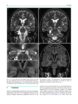 Fig. 4 A 21 year old man with complex partial seizures since the
age of 18 underwent left-side selective amgydalohippocampectomy.
On MRI, the left hippocampus is of normal size (a–c: 2 mm thick
T2-weighted fast spin echo images, d, e: 3 mm thick FLAIR fast spin
echo images). If there is an abnormality at all, hippocampal head
substructures (digitationes hippocampi, CA ﬁelds) are better to
delineate on the right (c) than on the left side
7 Treatment
Selective amygdalohippocampectomy (removal of amygdala,
hippocampus and part of the parahippocampal gyrus) and
anterior temporal lobectomy (additional removal of the
anterior 4.5 cm on the left and 5.5 cm on the right side) are
the most appropriate treatments and lead to seizure freeness
(Engel-class I) in 75% of patients. Another 12% beneﬁt
with a distinct reduction of seizure frequency (Engel class
II). With antiepileptic drugs only 8% of patients get seizure
free (Engel et al. 1993; Wiebe et al. 2001). Note that
96 H. Urbach
 