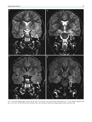 Fig. 5 Left-sided hippocampal sclerosis (b, d: hollow arrow) and ‘‘gray white matter demarcation loss’’ of the anterior temporal lobe
(a, c: arrow) in a 32 year old man with varicella zoster virus infection as infant and complex partial seizures since this time
Hippocampal Sclerosis 97
 