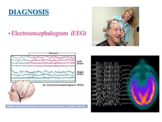 DIAGNOSIS
• Electroencephalogram (EEG)
 