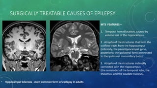 SURGICALLY TREATABLE CAUSES OF EPILEPSY
• Hippocampal Sclerosis - most common form of epilepsy in adults
MTS FEATURES –
1. Temporal horn dilatation, caused by
volume loss of the hippocampus.
2 . Atrophy of the structures that form the
outflow tracts from the hippocampus
(inferiorly, the parahippocampal gyrus,
posteriorly, the ipsilateral fornix connected
to the ipsilateral mammillary body).
3. Atrophy of the structures indirectly
connected with the hippocampus
(the remainder of the temporal lobe, the
thalamus, and the caudate nucleus).
 