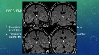 PROBLEMS IN DIAGNOSINS MTS WITH MRI
1. Comparing the volumes of the two hippocampi, including the inability to
detect bilateral hippocampal sclerosis .
2. Possibility of false lateralization in patients with an epileptogenic lesion that
expands the hippocampus.
 