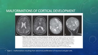 MALFORMATIONS OF CORTICAL DEVELOPMENT
• Type 1 - malformations resulting from abnormal proliferation of neuronal and glial cells.
 