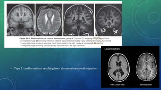 • Type 2 - malformations resulting from abnormal neuronal migration.
 