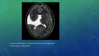 • Group III: malformations resulting from abnormal cortical organization.
• Polymicrogyria , Schizencephaly
 