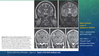 • FOCAL CORTICAL DYPLASIA – Type 2 b - Taylor’s FCD With Balloon cells
Most common
cause of
epilepsy in children
FCD 1- ASSOCIATED
WITH MTS 70%
FCD TYPE 2 -
“funnel” track
between the cortex
and the ventricle
 