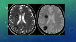 OTHER CAUSES -
• Tumors- contrast
• Vascular malformations – cavernoma – Hemosiderin - GRE
 