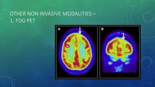 OTHER NON INVASIVE MODALITIES –
1. FDG PET
 