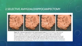 2.SELECTIVE AMYGDALOHIPPOCAMPECTOMY
 