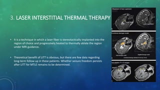 3. LASER INTERSTITIAL THERMAL THERAPY
• It is a technique in which a laser fiber is stereotactically implanted into the
region of choice and progressively heated to thermally ablate the region
under MRI guidance.
• Theoretical benefit of LITT is obvious, but there are few data regarding
long-term follow-up in these patients. Whether seizure freedom persists
after LITT for MTLE remains to be determined.
 
