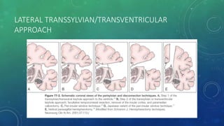 LATERAL TRANSSYLVIAN/TRANSVENTRICULAR
APPROACH
 