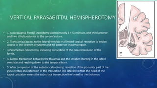 VERTICAL PARASAGITTAL HEMISPHEROTOMY
• 1. A parasagittal frontal craniotomy approximately 3 × 5 cm insize, one third anterior
and two thirds posterior to the coronal suture.
• 2. Transcortical access to the lateral ventricle via limited cortical resection to enable
access to the foramen of Monro and the posterior thalamic region.
• 3.Paramedian callosotomy, including transection of the posteriorcolumn of the
fornix.
• 4. Lateral transection between the thalamus and the striatum starting in the lateral
ventricle and reaching down to the temporal horn.
• 5. After completion of the anterior callosotomy, resection of the posterior part of the
gyrus rectus and extension of the transection line laterally so that the head of the
caput caudatum meets the substriatal transection line lateral to the thalamus
 