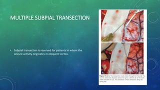 MULTIPLE SUBPIAL TRANSECTION
• Subpial transection is reserved for patients in whom the
seizure activity originates in eloquent cortex.
 