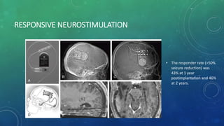 RESPONSIVE NEUROSTIMULATION
• The responder rate (>50%
seizure reduction) was
43% at 1 year
postimplantation and 46%
at 2 years.
 