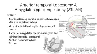 Epilepsy surgery | PPTX