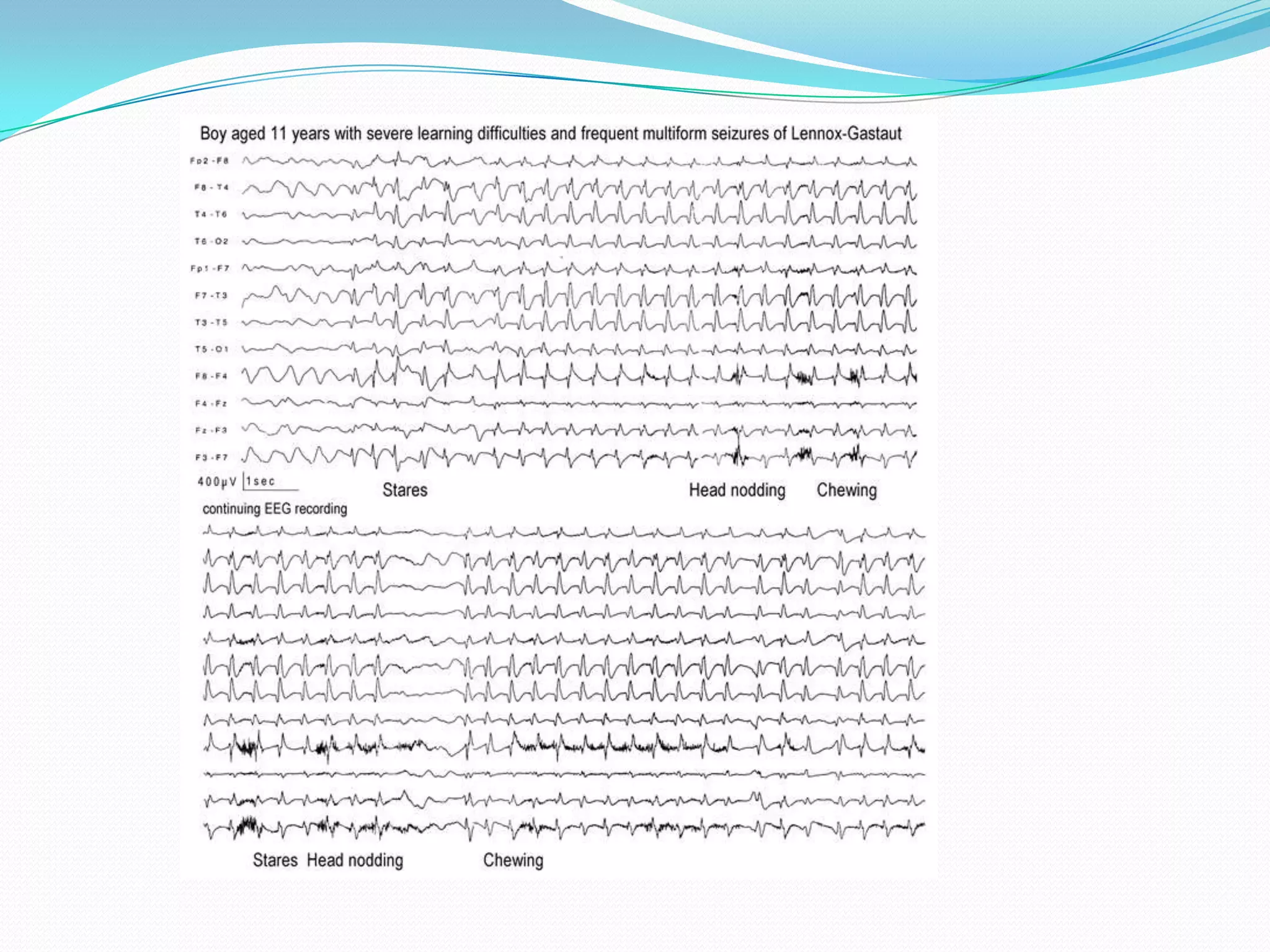 Epileptic encephalopathy -EEG | PPT