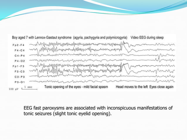 Epileptic encephalopathy -EEG | PPT