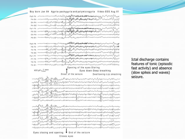 Epileptic encephalopathy -EEG | PPT