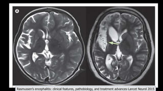 Rasmussen’s encephalitis: clinical features, pathobiology, and treatment advances-Lancet Neurol 2015
 