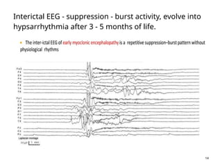 EPILEPTIC ENCEPHALOPATHY - INFANT, CHILDREN AND ADULT | PPTX