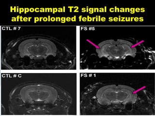 Hippocampal T2 signal changes
after prolonged febrile seizures

 