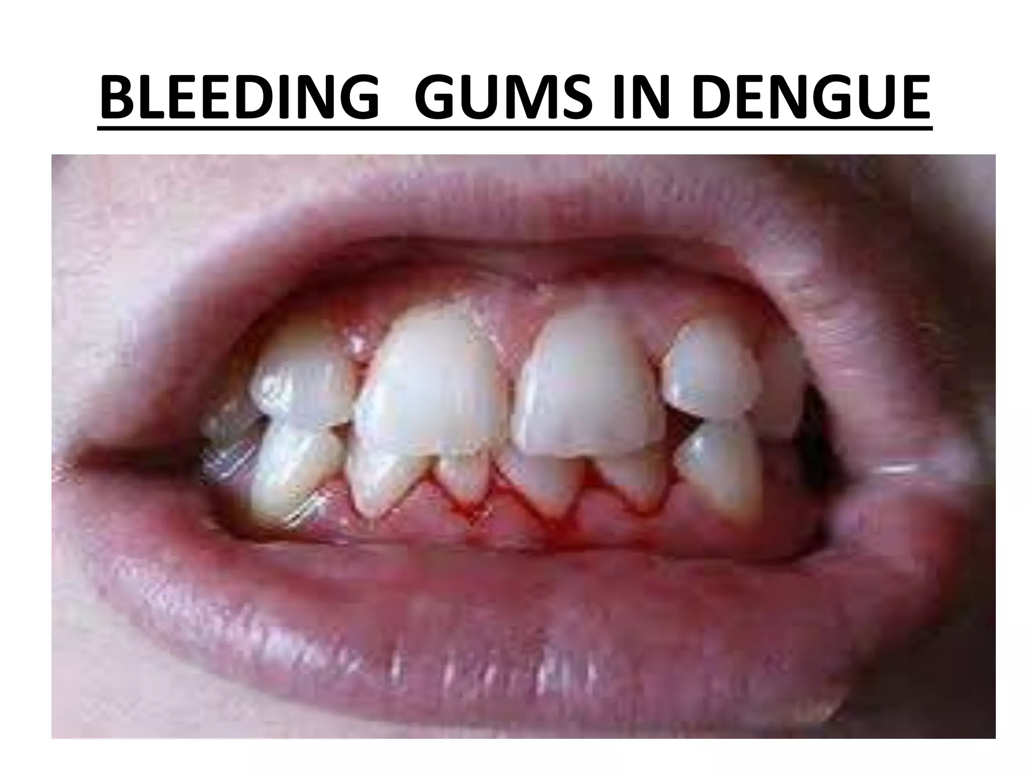 BLEEDING GUMS IN DENGUE
 