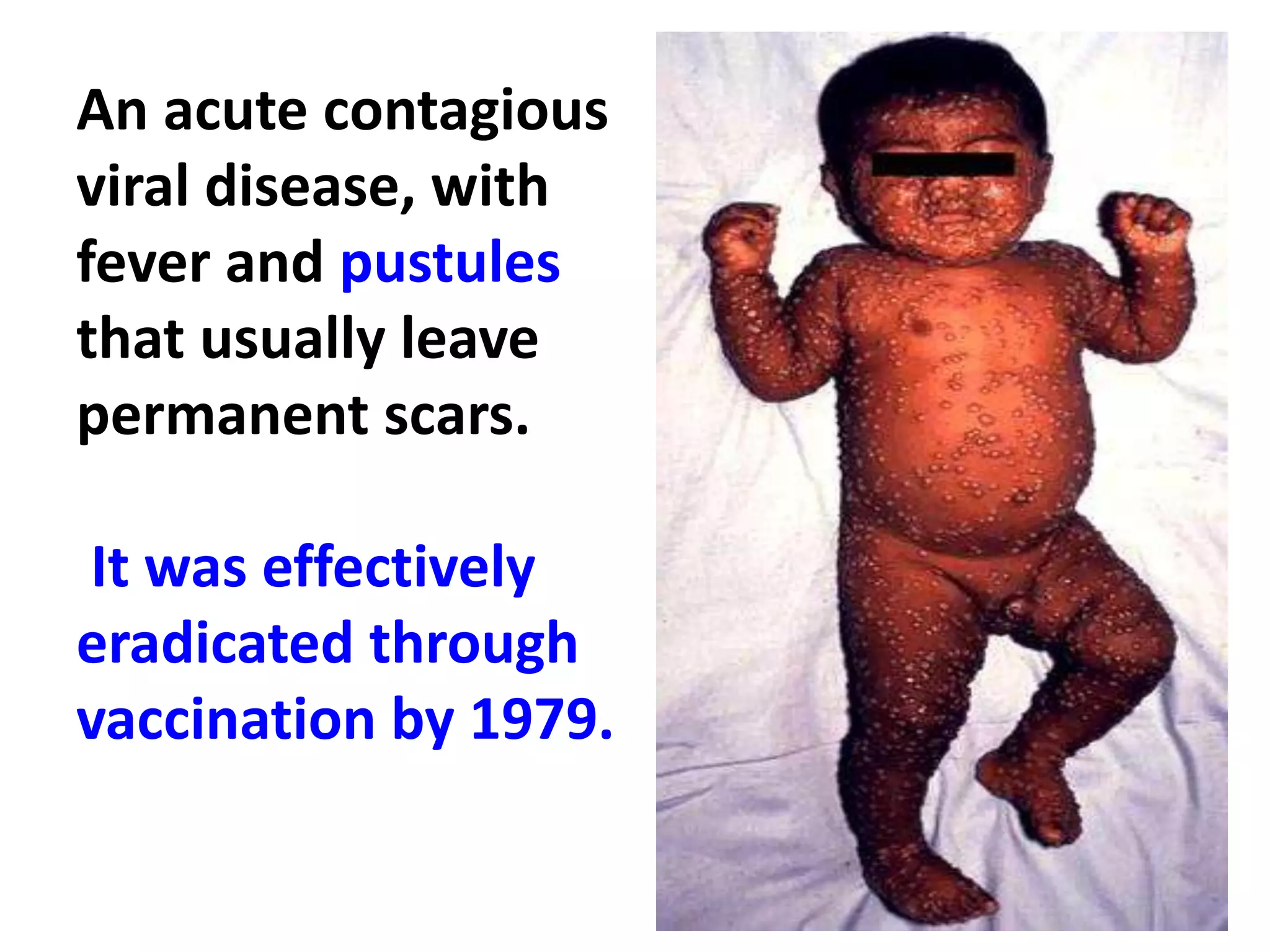 An acute contagious
viral disease, with
fever and pustules
that usually leave
permanent scars.
It was effectively
eradicated through
vaccination by 1979.
 