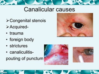 Canalicular causes
Congenital stenois
Acquired-
• trauma
• foreign body
• strictures
• canaliculitis-
pouting of punctum
 