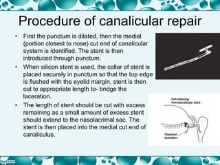 Procedure of canalicular repair
• First the punctum is dilated, then the medial
(portion closest to nose) cut end of canalicular
system is identified. The stent is then
introduced through punctum.
• When silicon stent is used, the collar of stent is
placed securely in punctum so that the top edge
is flushed with the eyelid margin, stent is then
cut to appropriate length to- bridge the
laceration.
• The length of stent should be cut with excess
remaining as a small amount of excess stent
should extend to the nasolacrimal sac. The
stent is then placed into the medial cut end of
canaliculus.
 