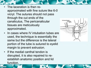 • The laceration is then re-
approximated with fine suture like 6-0
vicryl. The sutures should not pass
through the cut ends of the
canaliculus, The pericanalicular
tissues are meticulously
approximated.
• In cases where IV intubation tubes are
used, the technique is essentially the
same but the difference is the lateral
portion of the tube is sutured to eyelid
margin to prevent extrusion.
• If the medial canthal tendon is
disrupted, it is also repaired to re-
establish anatomic position and lid
function.
 