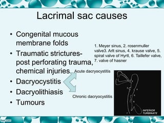 Lacrimal sac causes
• Congenital mucous
membrane folds
• Traumatic strictures-
post perforating trauma,
chemical injuries
• Dacryocystitis
• Dacryolithiasis
• Tumours
1. Meyer sinus, 2. rosenmuller
valve3. Arlt sinus, 4. krause valve, 5.
spiral valve of Hyrtl, 6. Taillefer valve,
7. valve of hasner
Acute dacryocystitis
Chronic dacryocystitis
 