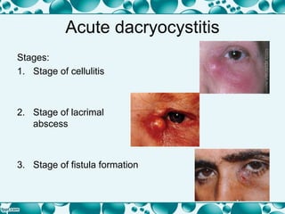 Acute dacryocystitis
Stages:
1. Stage of cellulitis
2. Stage of lacrimal
abscess
3. Stage of fistula formation
 