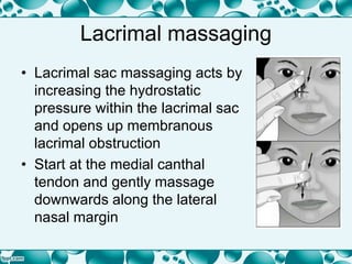 Lacrimal massaging
• Lacrimal sac massaging acts by
increasing the hydrostatic
pressure within the lacrimal sac
and opens up membranous
lacrimal obstruction
• Start at the medial canthal
tendon and gently massage
downwards along the lateral
nasal margin
 