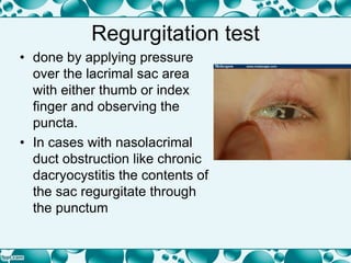 Regurgitation test
• done by applying pressure
over the lacrimal sac area
with either thumb or index
finger and observing the
puncta.
• In cases with nasolacrimal
duct obstruction like chronic
dacryocystitis the contents of
the sac regurgitate through
the punctum
 
