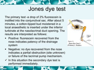 Jones dye test
The primary test -a drop of 2% fluorescein is
instilled into the conjunctival sac. After about 5
minutes, a cotton-tipped bud moistened in a
local anaesthetic is inserted under the inferior
turbinate at the nasolacrimal duct opening. The
results are interpreted as follows:
 Positive: fluorescein recovered from the
nose indicates patency of the drainage
system
 Negative: no dye recovered from the nose
indicates a partial obstruction (site unknown)
or failure of the lacrimal pump mechanism.
 In this situation the secondary dye test is
performed immediately.
 