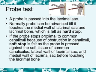 Probe test
• A probe is passed into the lacrimal sac.
• Normally probe can be advanced till it
touches the medial wall of lacrimal sac and
lacrimal bone, which is felt as hard stop.
• If the probe stops proximal to common
canaliculi because of obstruction in canaliculi,
soft stop is felt as the probe is pressed
against the soft tissue of common
canaliculus, lateral wall of lacrimal sac, and
medial wall of lacrimal sac before touching
the lacrimal bone
 