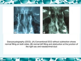 Dacryocystography (DCG). (A) Conventional DCG without subtraction shows
normal filling on both sides; (B) normal left filling and obstruction at the junction of
the right sac and nasolacrimal duct
 