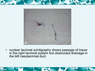 • nuclear lacrimal scintigraphy shows passage of tracer
in the right lacrimal system but obstructed drainage in
the left nasolacrimal duct
 