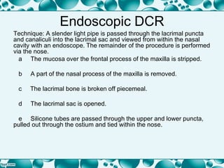 Endoscopic DCR
Technique: A slender light pipe is passed through the lacrimal puncta
and canaliculi into the lacrimal sac and viewed from within the nasal
cavity with an endoscope. The remainder of the procedure is performed
via the nose.
a The mucosa over the frontal process of the maxilla is stripped.
b A part of the nasal process of the maxilla is removed.
c The lacrimal bone is broken off piecemeal.
d The lacrimal sac is opened.
e Silicone tubes are passed through the upper and lower puncta,
pulled out through the ostium and tied within the nose.
 