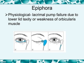 Epiphora
Physiological- lacrimal pump failure due to
lower lid laxity or weakness of orbicularis
muscle
 