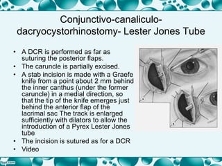 Conjunctivo-canaliculo-
dacryocystorhinostomy- Lester Jones Tube
• A DCR is performed as far as
suturing the posterior flaps.
• The caruncle is partially excised.
• A stab incision is made with a Graefe
knife from a point about 2 mm behind
the inner canthus (under the former
caruncle) in a medial direction, so
that the tip of the knife emerges just
behind the anterior flap of the
lacrimal sac The track is enlarged
sufficiently with dilators to allow the
introduction of a Pyrex Lester Jones
tube
• The incision is sutured as for a DCR
• Video
 