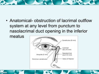 • Anatomical- obstruction of lacrimal outflow
system at any level from punctum to
nasolacrimal duct opening in the inferior
meatus
 