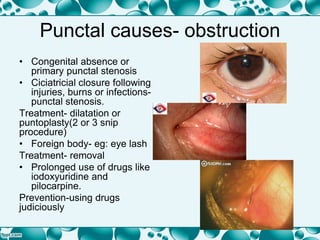 Punctal causes- obstruction
• Congenital absence or
primary punctal stenosis
• Ciciatricial closure following
injuries, burns or infections-
punctal stenosis.
Treatment- dilatation or
puntoplasty(2 or 3 snip
procedure)
• Foreign body- eg: eye lash
Treatment- removal
• Prolonged use of drugs like
iodoxyuridine and
pilocarpine.
Prevention-using drugs
judiciously
 