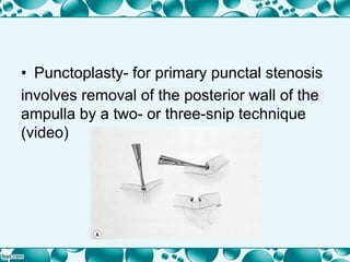 • Punctoplasty- for primary punctal stenosis
involves removal of the posterior wall of the
ampulla by a two- or three-snip technique
(video)
 