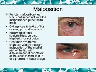 Malposition
 Punctal malposition- tear
film is not in contact with the
malpositioned punctum to
drain.
• Old age due to laxity of lids
causing punctal eversion
• Following chronic
conjunctivitis, chronic
blepheritis or ectropion
• Centurion syndrome-
characterized by anterior
malposition of the medial
part of the lid, with
displacement of puncta out
of the lacus lacrimalis due
to a prominent nasal bridge
 
