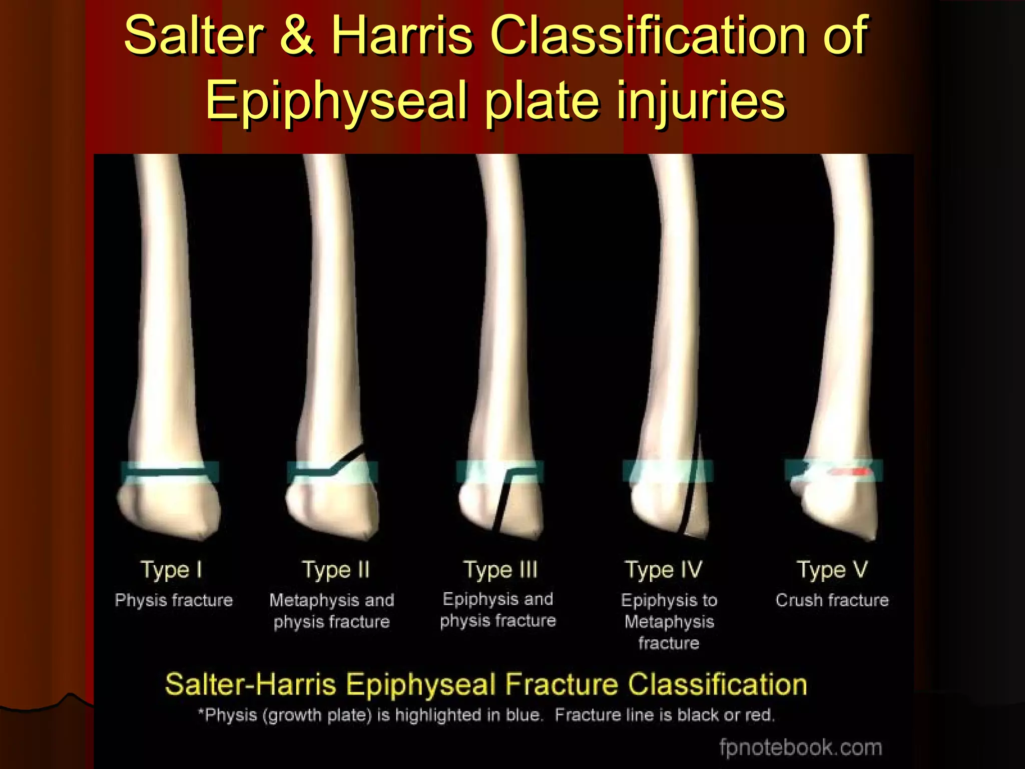 Salter & Harris Classification of
Epiphyseal plate injuries