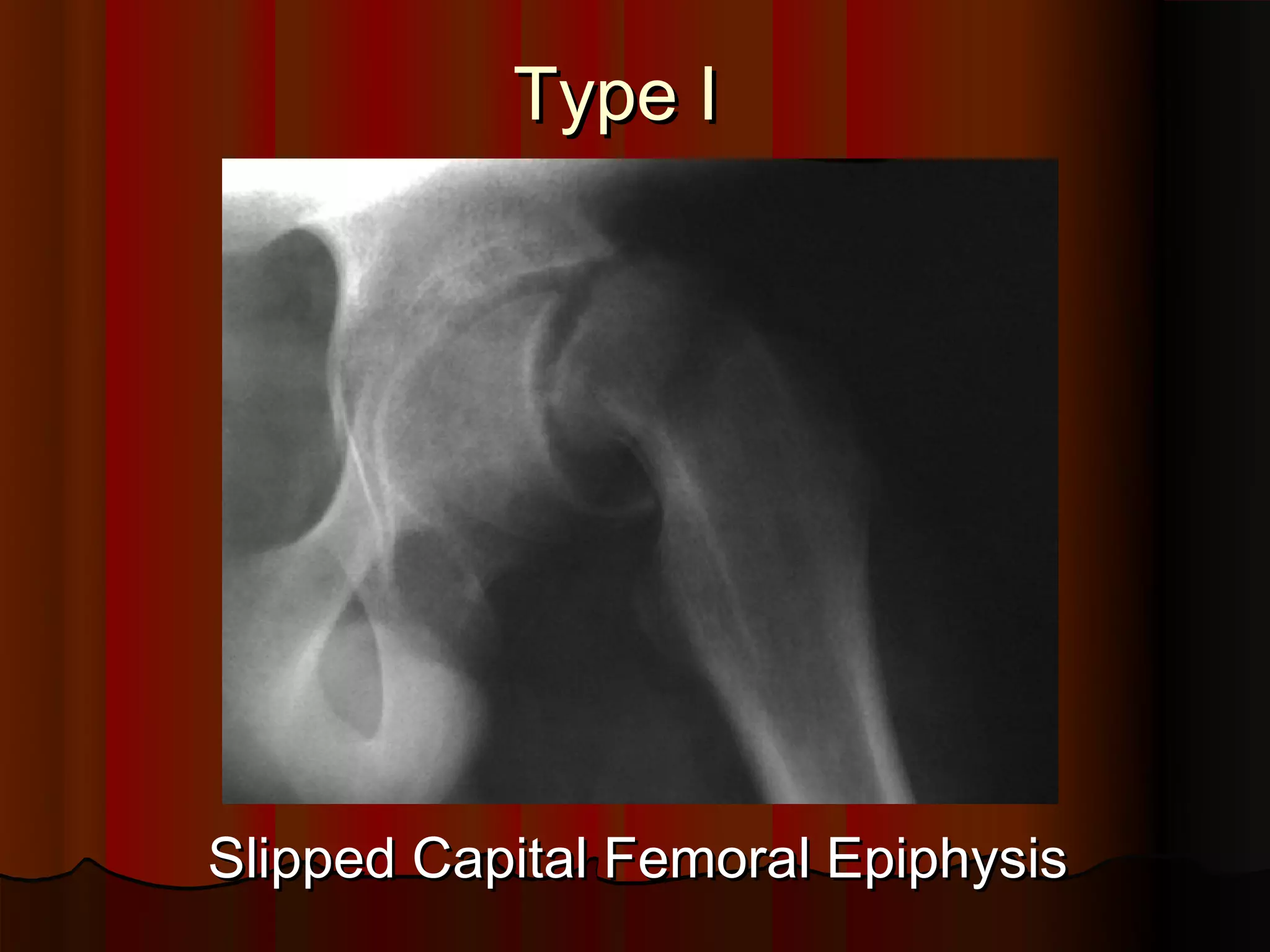 Type I
Slipped Capital Femoral Epiphysis